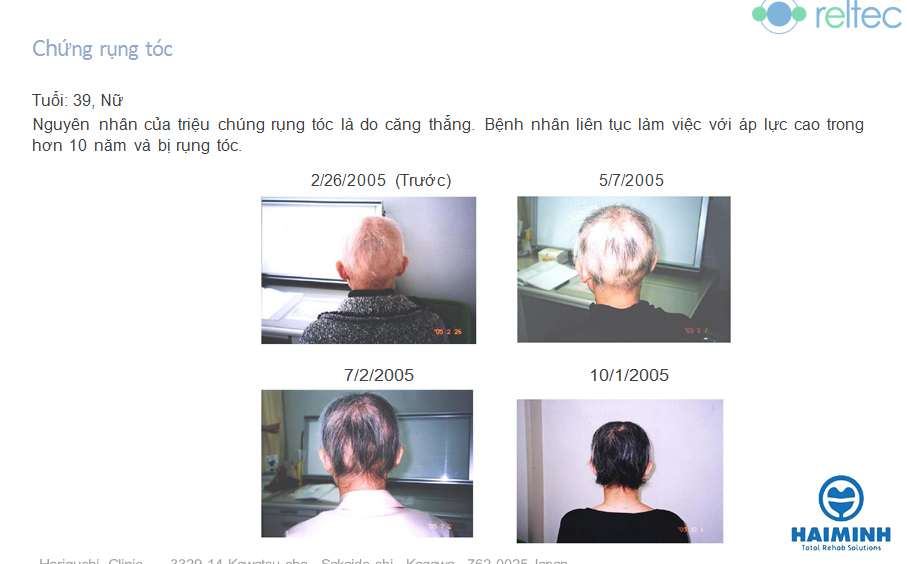 Bệnh nhân mắc chứng rụng tóc